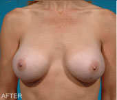 Patient # 51921 After Photo # 2